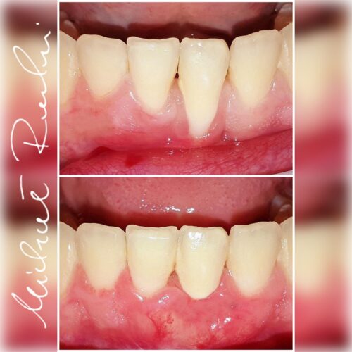 leczenie-periodontologiczne-chirurgiczne-dentysta-bydgoszcz_4